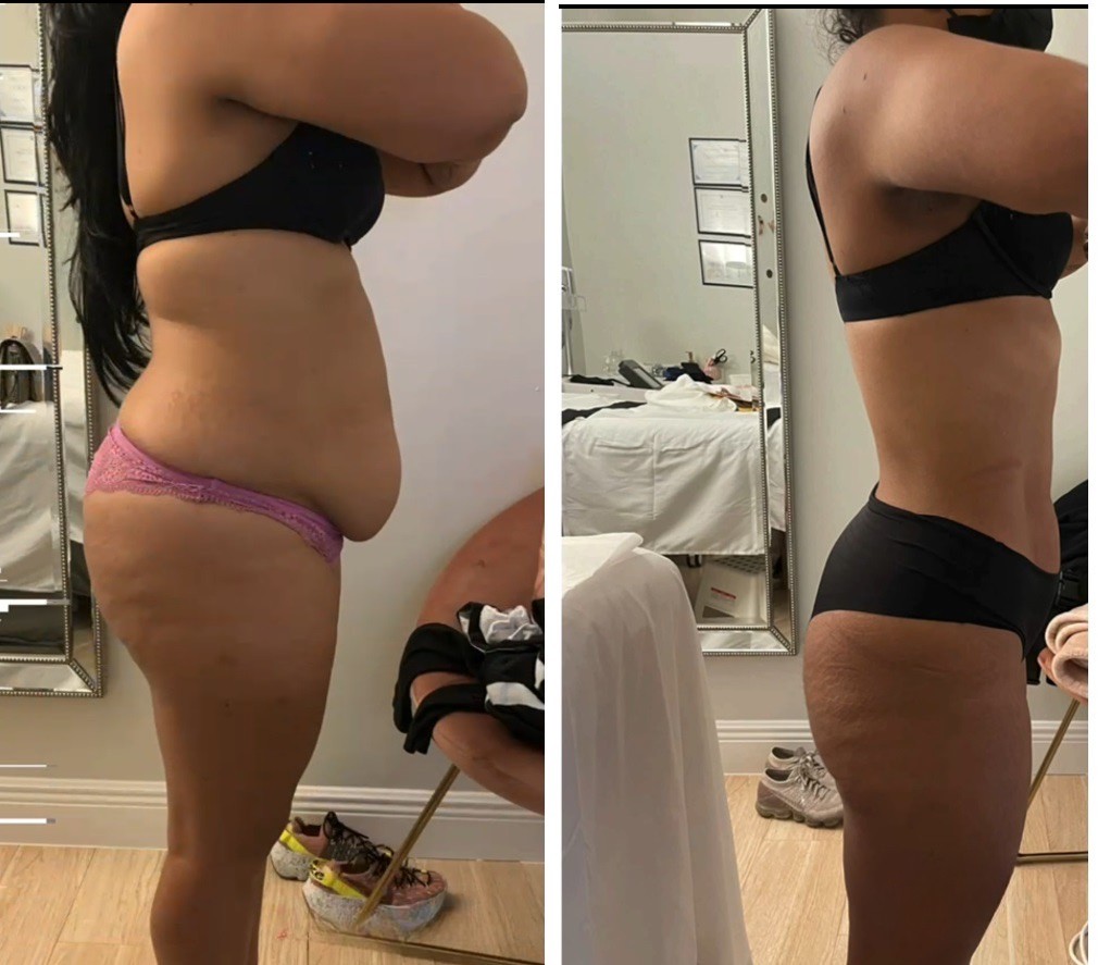 kriolipoliza kontrastowa