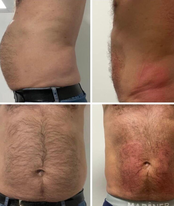 Kriolipoliza kontrastowa