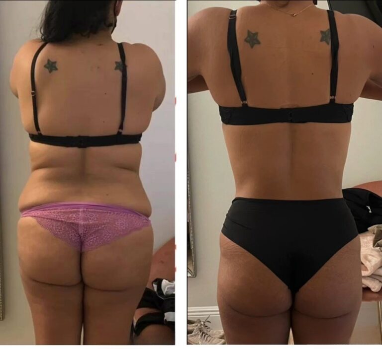 kriolipoliza kontrastowa