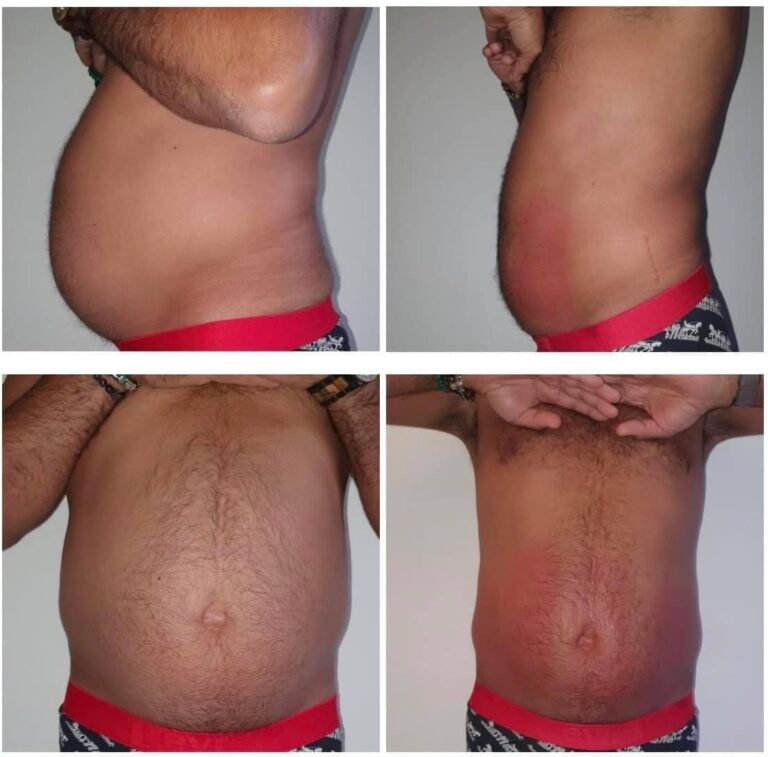 Kriolipoliza kontrastowa